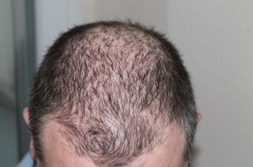 Proscar (Finalo) 1 mg: Effective Hair Loss Treatment